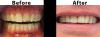 Cosmetic Dental Work - Single Crown