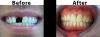 Cosmetic Dental Work - Implants and Crowns