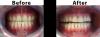Cosmetic Dental Work - Invisalign and Veneers