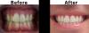 Cosmetic Dental Work - Invisalign