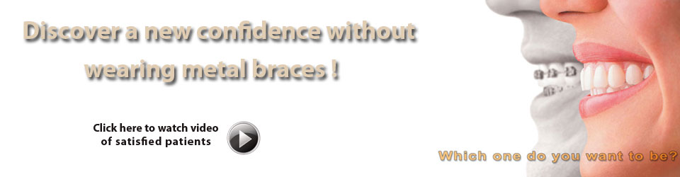 Get Invisalign clear braces - Serving Fairfax Virginia, McLean VA, and Herndon VA community.